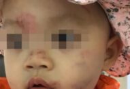 Chính quyền thông tin vụ mặt bé 14 tháng tuổi bầm tím ngày đầu đi học