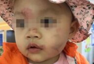 QQ8839 nhà cái: Cháu bé 14 tháng tuổi bị bầm tím mặt sau ngày đầu đi học